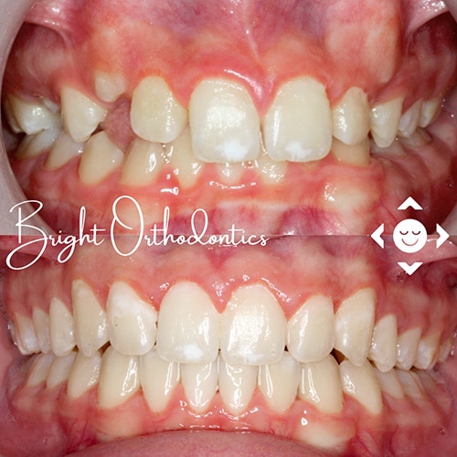 Before-After-5